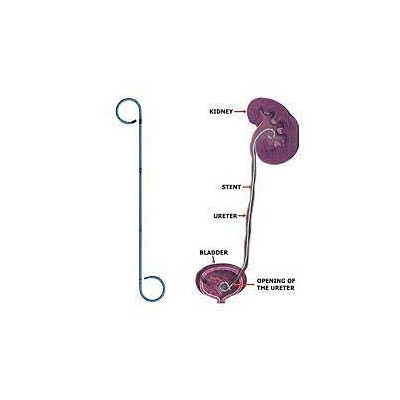 SONDE JJ URETERAL