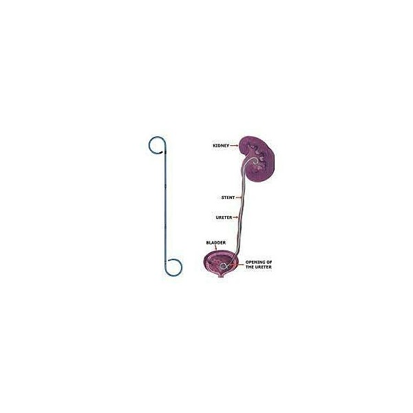 SONDE JJ URETERAL